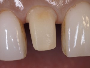 ノナカデンタルクリニック/右上の前歯の治療