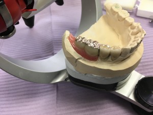 cspリーゲルテレスコープ義歯/ノナカデンタルクリニック