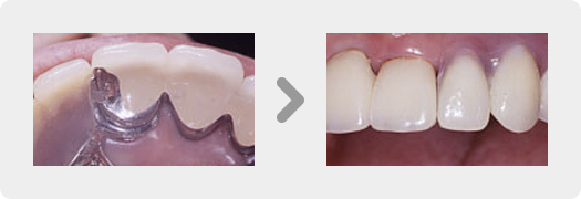 コバルトクロム部分床義歯、歯冠内アタッチメント
